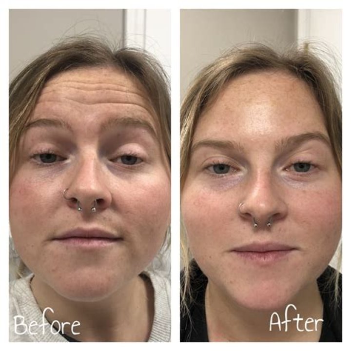 Discover The Transformative Power Of Jelly Roll Botox: Before And After Unveiled